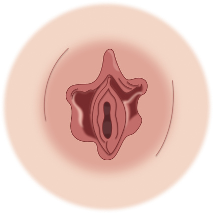 Ícone ilustrativo de ninfoplastia