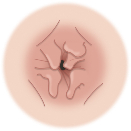 Ícone ilustrativo de plicoma anal